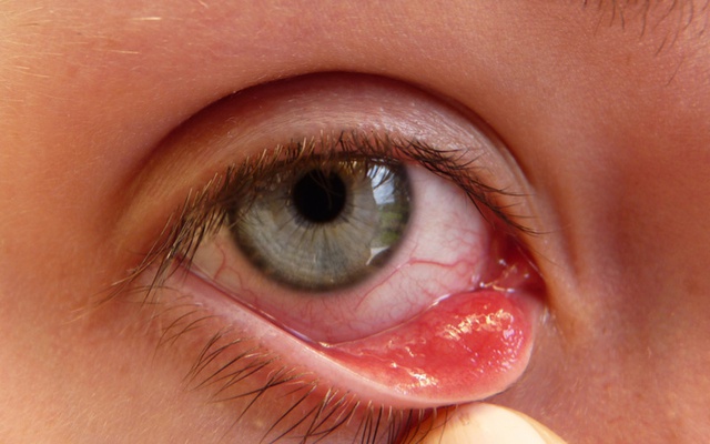 Các bệnh nhiễm trùng ở mắt thường gặp - Ảnh 2.