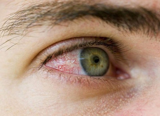 Các bệnh nhiễm trùng ở mắt thường gặp - Ảnh 7.