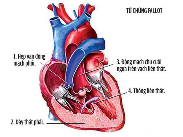 Một số dị tật sơ sinh thường gặp ở trẻ, cha mẹ nên biết để can thiệp sớm - Ảnh 4.