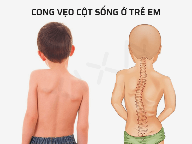 Những yếu tố nguy cơ gây gù vẹo cột sống ở trẻ em cha mẹ cần biết - Ảnh 2.