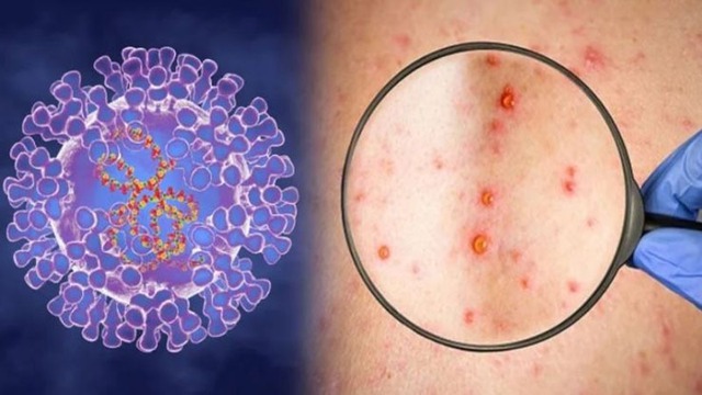 Bệnh đậu mùa khỉ: Con đường lây truyền và biện pháp có thể ngăn ngừa nhiễm virus - Ảnh 2.