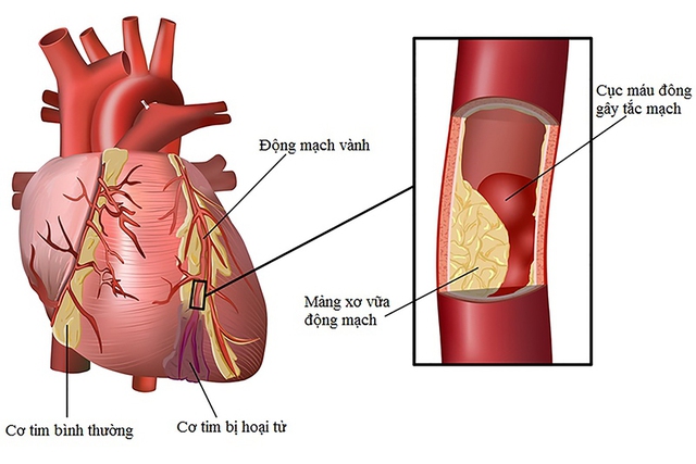 Mức độ nguy hiểm của viêm cơ tim và biểu hiện - Ảnh 1.