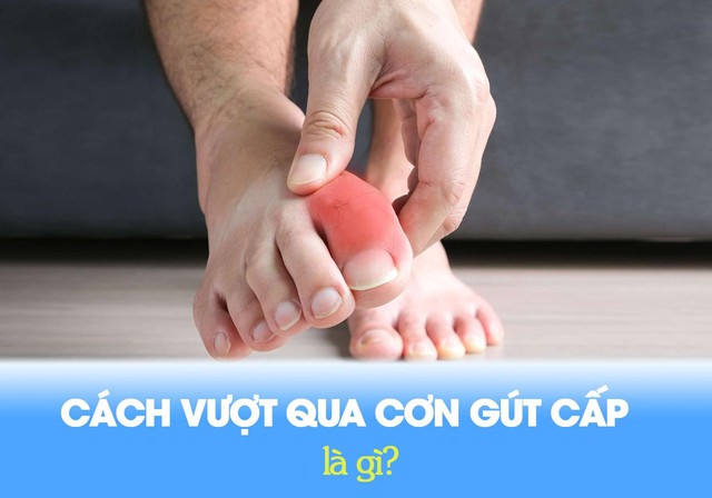 Giải pháp giúp giảm đau cơn gút cấp an toàn và hiệu quả - Ảnh 1.