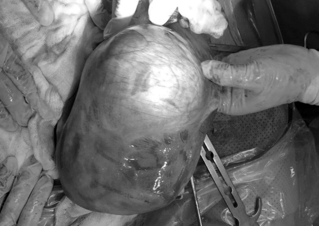 Sản phụ mang khối u lớn trong khi mang thai - Ảnh 1.
