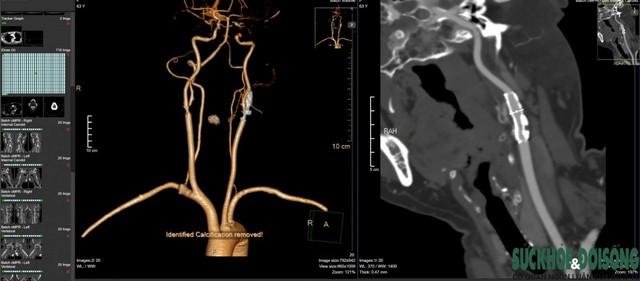 Bệnh viện ĐK TP Vinh ứng dụng máy CT.Scanner 256 lát cắt tầm soát bệnh tim mạch - Ảnh 2.