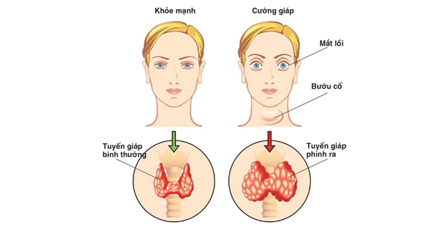 Dấu hiệu sau đây chứng tỏ bạn mắc bệnh cường giáp - Ảnh 1.