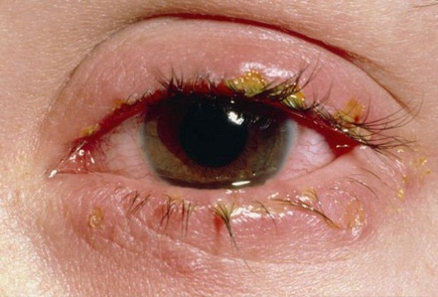 Triệu chứng mắt đổ ghèn là biểu hiện của bệnh gì? - Ảnh 1.