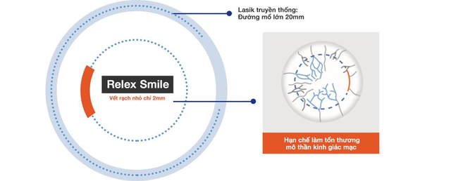 Mổ cận nhẹ nhàng, hồi phục nhanh với phẫu thuật ReLEx SMILE - Ảnh 1.