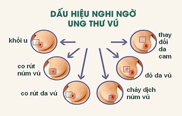 Có khối u ở vú, khi nào nghi ngờ là ung thư? - Ảnh 4.