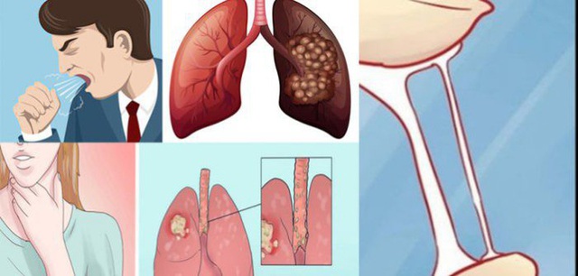 Biểu hiện sớm ung thư phổi ở giai đoạn đầu - Ảnh 1.