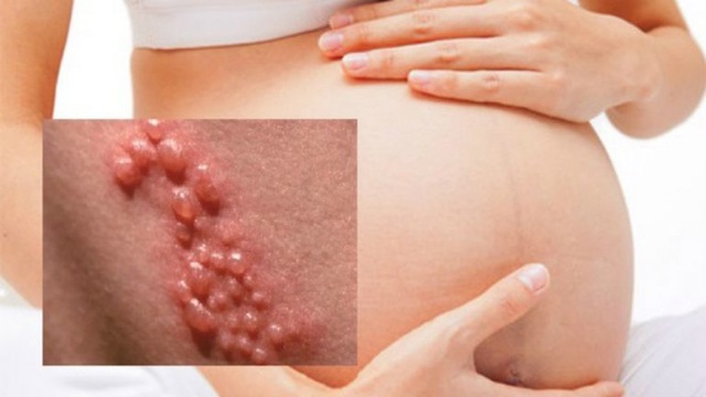 Những rủi ro khi mắc bệnh lậu ở phụ nữ mang thai - Ảnh 4.