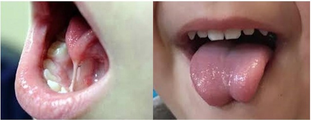 Dính thắng lưỡi (Tongue-tie/Ankyloglossia) hay còn gọi là dính phanh lưỡi/ngắn hãm lưỡi/dính lưỡi, đây là một bất thường về cấu trúc giải phẫu bẩm sinh, với tỷ lệ gặp ở nam và nữ là 3:1. Ảnh minh họa