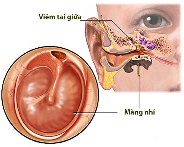 Thủng màng nhĩ chỉ vì… chủ quan bệnh viêm tai giữa - Ảnh 1.