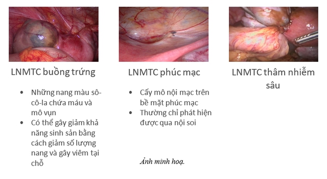 Phụ nữ đừng im lặng chịu đựng cơn đau lạc nội mạc tử cung - Ảnh 3.