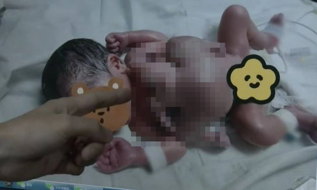 Sửng sốt bé trai sơ sinh có 4 tay 4 chân  - Ảnh 1.