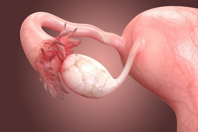 Nguyên nhân u nang buồng trứng và cách hỗ trợ bệnh từ thảo dược - Ảnh 1.