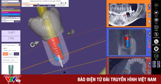 Tọa đàm: Ưu điểm công nghệ Safe Tech trong trồng răng Implant - Ảnh 3. Tọa đàm: Ưu điểm công nghệ Safe Tech trong trồng răng Implant - Ảnh 3.