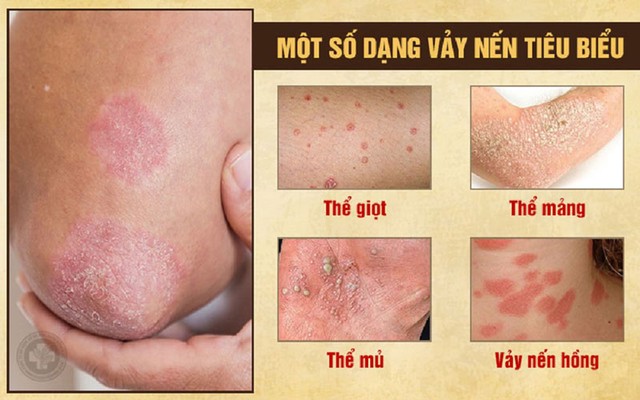 Điều trị vảy nến trên bệnh nhân HIV - Những thông tin khoa học - Ảnh 2.