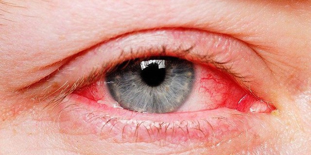 Mùa mưa bão cần chủ động phòng bệnh đau mắt đỏ - Ảnh 2.