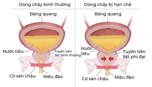 Tiểu tiện là một động tác theo ý muốn, có sự kết hợp giữa sự co bóp mạnh của bàng quang và sự giãn nở thật rộng của cổ bàng quang. Ảnh minh họa