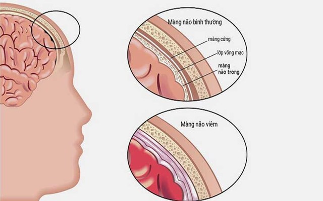 Viêm màng não mủ cần phân biệt với các loại bệnh nào? - Ảnh 2.