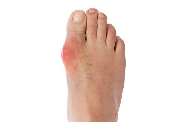 Bệnh gout có thể làm ảnh hưởng đến sinh lý phái mạnh - Ảnh 1.