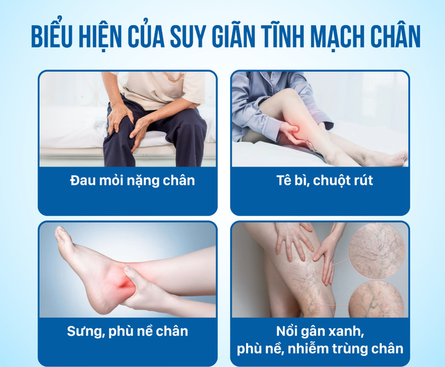 Ai có nguy cơ mắc bệnh suy giãn tĩnh mạch chân? - Ảnh 1.