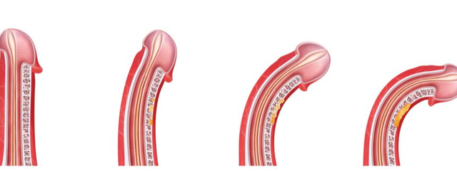 Nhiều nam giới bị cong dương vật nhưng mức độ cong nào cần đi khám chuyên khoa ngay? - Ảnh 2.