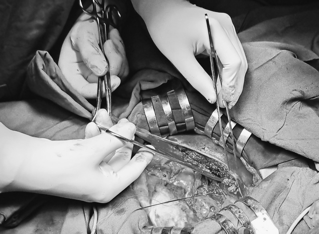 3 giờ phẫu thuật cắt thùy gan cho bệnh nhân ung thư đường mật trong gan

 - Ảnh 1.