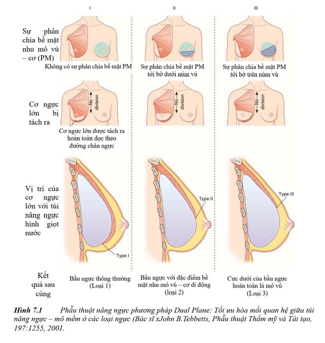 Nâng ngực Dual Plane - kỹ thuật thường quy trong nâng ngực Harmonic - Ảnh 2.