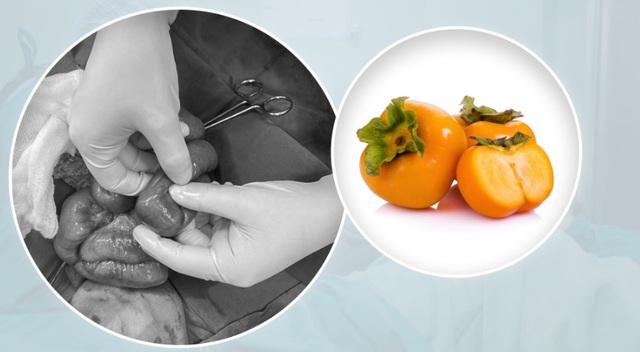 Bệnh nhi 7 tuổi tắc ruột vì ăn quả hồng giòn, phải nhập viện cấp cứu - Ảnh 2.