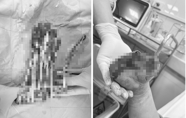 Mổ chuyển thành công 2 ngón chân tạo hình 2 ngón tay cho bệnh nhân dập đứt bàn tay - Ảnh 3.