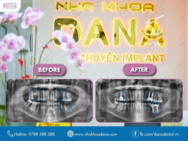 Nha khoa cấy ghép răng Implant uy tín tại Đà Nẵng - Ảnh 1.