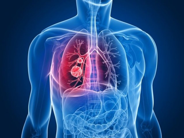 Ung thư phổi giai đoạn cuối sống được bao lâu - Ảnh 3.
