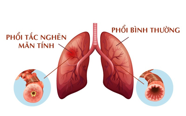 Bệnh phổi tắc nghẽn mạn tính: Nguyên nhân gây tử vong xếp hàng thứ 3 - Ảnh 2.