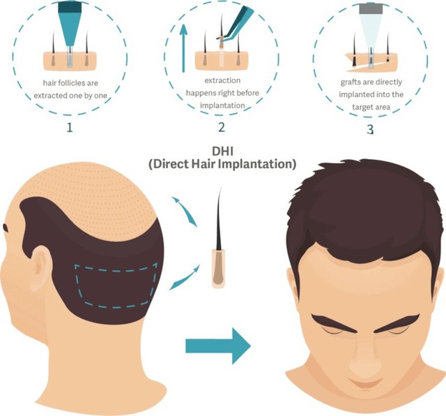 Giải mã phương pháp cấy tóc tiên tiến hiện nay - Ảnh 2.