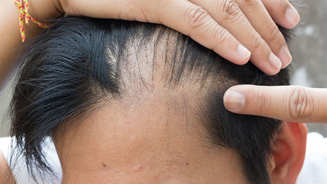 Rụng tóc ở nam giới do nhiều nguyên nhân gây ra như do di truyền, thay đổi hormone, ...