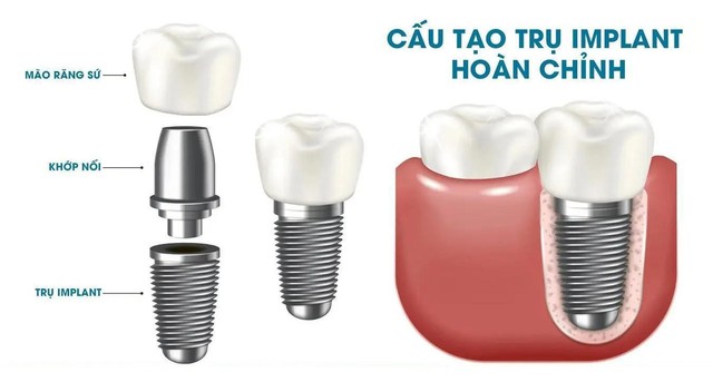 Bảng giá trồng răng Implant tại Nha khoa Nhân Tâm- Ảnh 1.