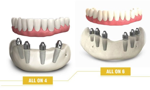 Bảng giá trồng răng Implant tại Nha khoa Nhân Tâm- Ảnh 2.