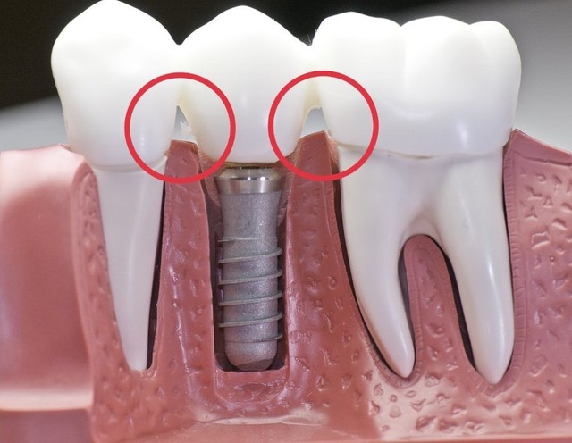 Cảnh báo tình trạng giắt răng sau cấy ghép implant- Ảnh 1.