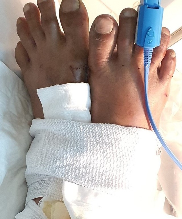 Bệnh viện Đa khoa Bình Dương 'táo bạo' thực hiện kỹ thuật khó, giúp người bệnh giữ lại chân đứt lìa- Ảnh 2.