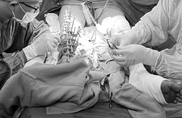 Bệnh viện Đa khoa Bình Dương 'táo bạo' thực hiện kỹ thuật khó, giúp người bệnh giữ lại chân đứt lìa- Ảnh 3.
