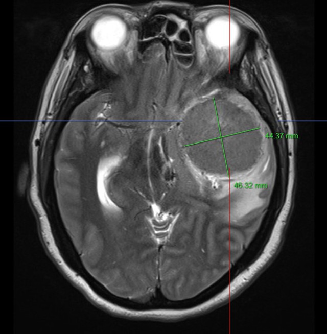 Đau đầu nhiều ngày, bệnh nhân nhập viện với khối u màng não có kích thước khổng lồ - Ảnh 2.