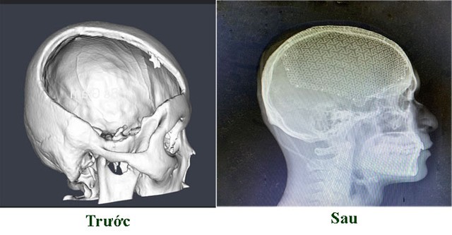 Phẫu thuật tạo hình sọ não bằng Titanium 3D - Ảnh 4.
