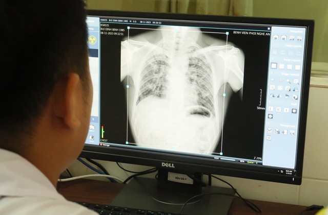 Vụ 5 công nhân tử vong do bụi phổi: Khám phát hiện bệnh nghề nghiệp cho công nhân - Ảnh 5.