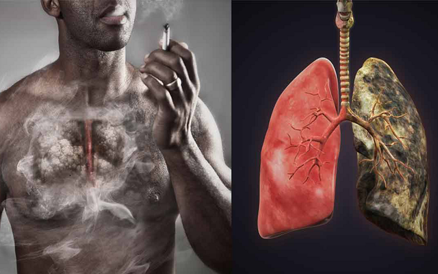 Những tiến bộ trong mô hình điều trị ung thư phổi- Ảnh 1.
