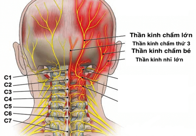 Đau đầu 'kinh niên' vì sao? - Ảnh 1.