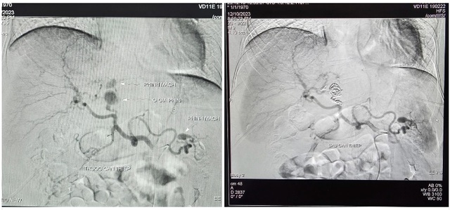 Bệnh viện Đa khoa TW Cần Thơ cứu thành công bệnh nhân vỡ phình động mạch gan hiếm gặp- Ảnh 1.