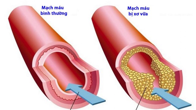 Bệnh lý tim mạch, mỡ máu, xơ vữa mạch máu, suy giảm đề kháng - Nguyên nhân và cách phòng ngừa- Ảnh 1.