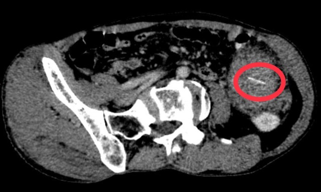 Bác sĩ khuyến cáo gì khi bị hóc xương- Ảnh 1.